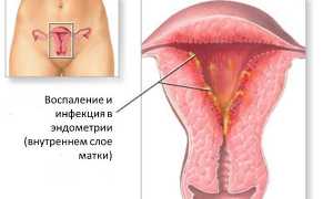 Зачем проводится лапароскопия при бесплодии