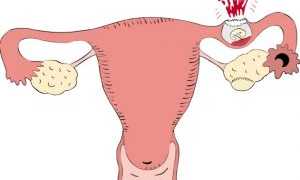 Основные признаки и симптомы, как определить внематочную беременность на ранних сроках