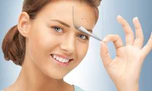 Прыщи как признак беременности: почему появляются и чем лечить