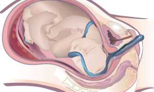 Опасное выпадение пуповины: как помочь маме и ребенку