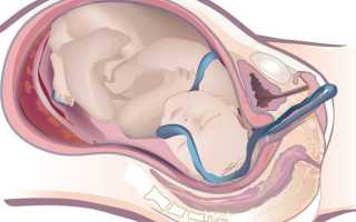 Опасное выпадение пуповины: как помочь маме и ребенку