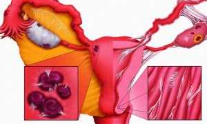 Неприятная и плохо диагностируемая патология — эндометриоз после кесарева