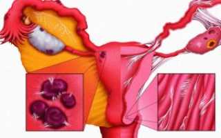 Неприятная и плохо диагностируемая патология — эндометриоз после кесарева