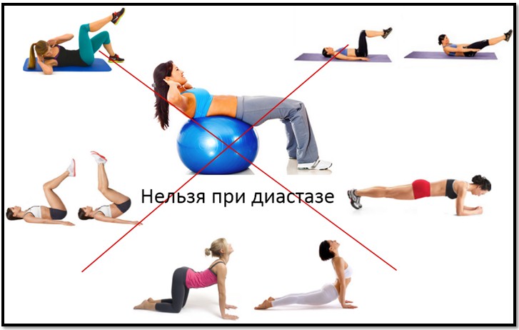 Что нельзя делать при диастазе Запрещенные при диастазе упражнения