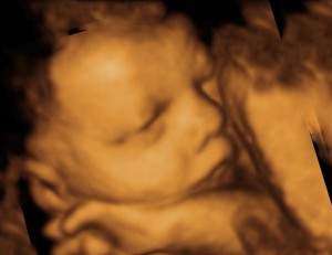 Что покажет 3Д, 4Д УЗИ Результаты 3Д УЗИ