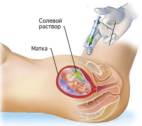 Искусственные роды
