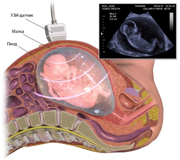 диагностика маловодия