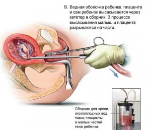 Процедура проведения вакуумного аборта Мини-аборт на ранних сроках