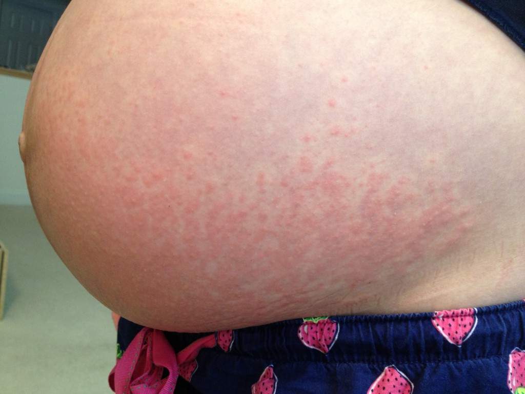 аллергия на животе при беременности
