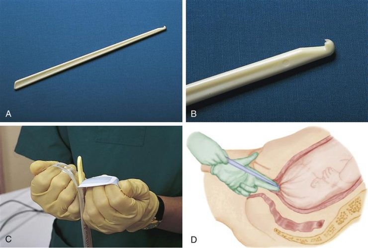 вскрытие плодного пузыря
