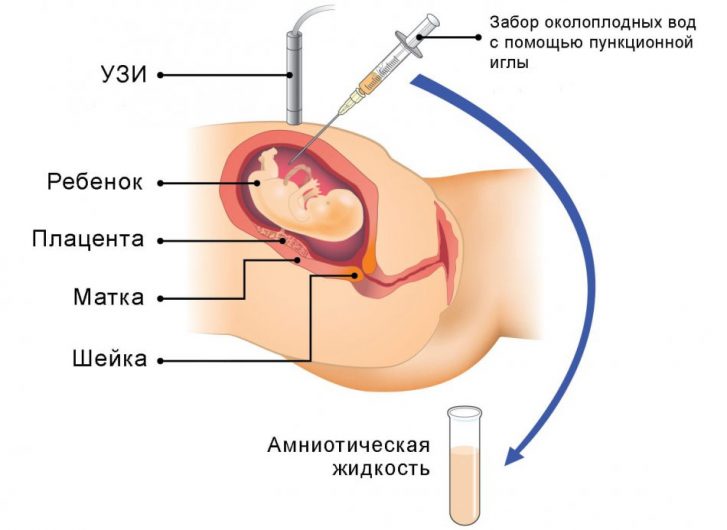 методика проведения амниоцентеза при маловодии