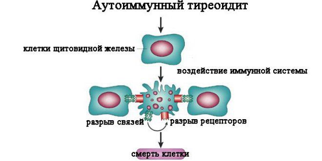 Гипотиреоз при беременности