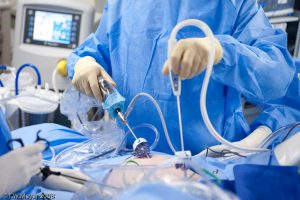 Операция лапароскопия Лапароскопия при поликистозе яичников