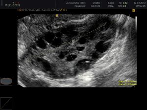 Результат УЗИ УЗИ при СПКЯ