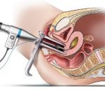 Планирование беременности после гистероскопии Беременность после гистероскопии
