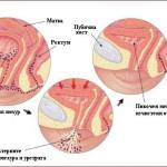 Цистит у беременных Цистит при беременности на ранних сроках