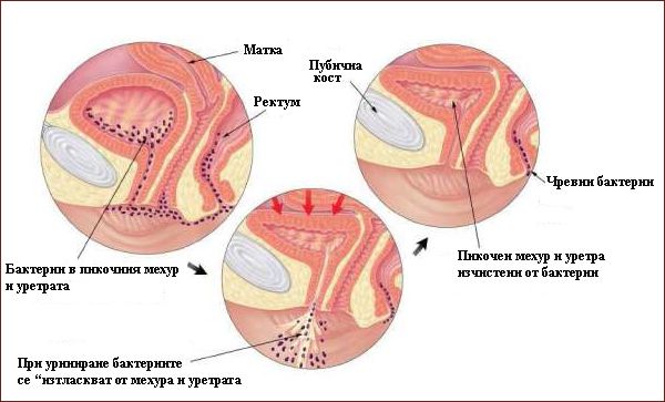 Цистит при беременности на ранних сроках