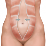 Причины диастаза прямых мышц живота после родов Диастаз прямых мышц живота