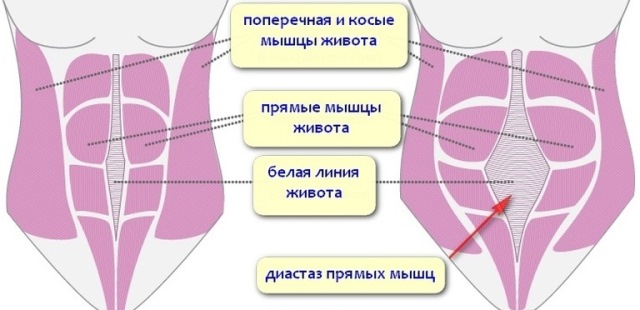 Диастаз прямых мышц живота после родов Что такое диастаз прямых мышц живота