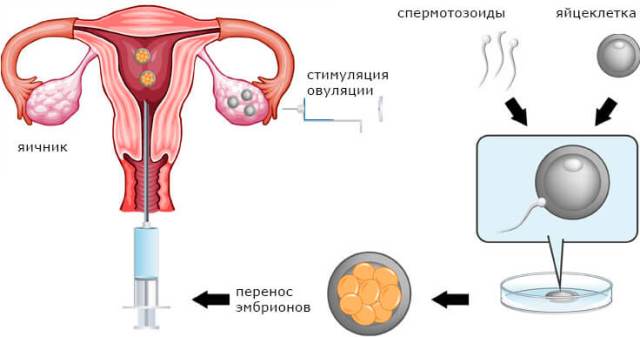 Процедура ЭКО Экстракорпоральное оплодотворение