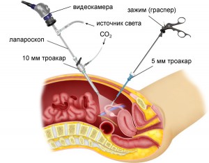 Операция лапароскопия Лапароскопия как метод лечения бесплодия у женщин