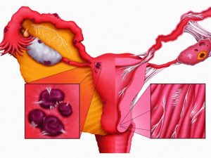 endometrioz-posle-kesareva Эндометриоз после кесарева