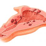 Причины эндометриоза после кесарева Эндометриоз после кесарева