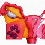 Причины и симптомы эндометриоза после родов Эндометриоз после родов