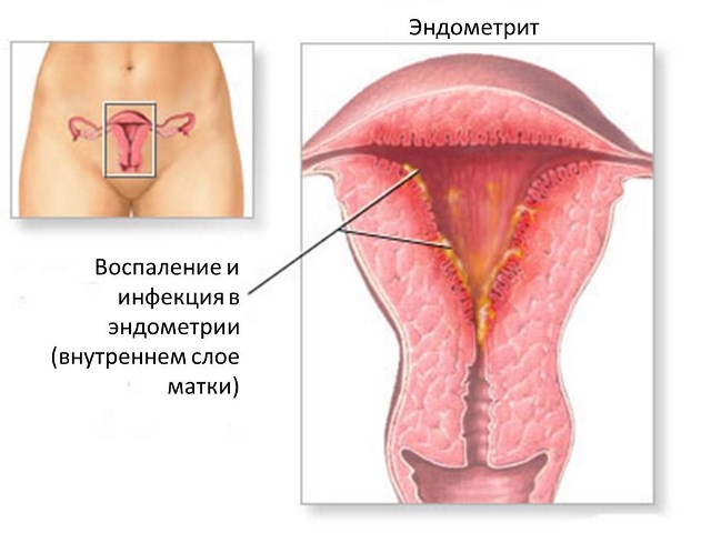 Симптомы эндометрита после родов Эндометрит после родов
