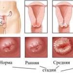 Эрозия шейки матки Симптомы и лечение эрозии шейки матки
