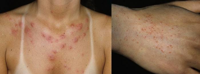 Кожа во время беременности