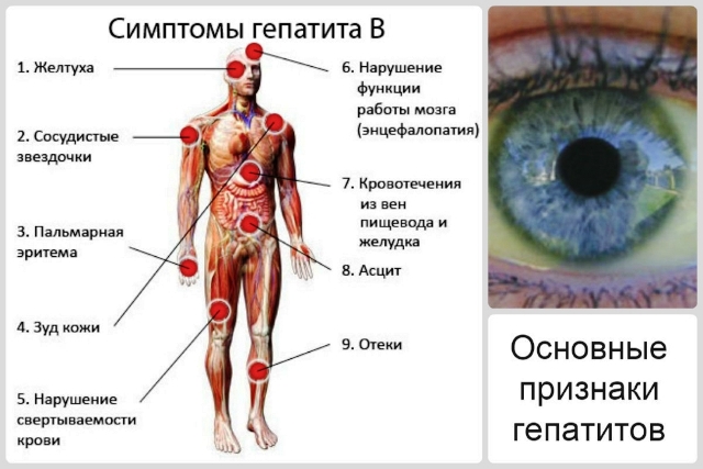 Что такое гепатит В Гепатит В