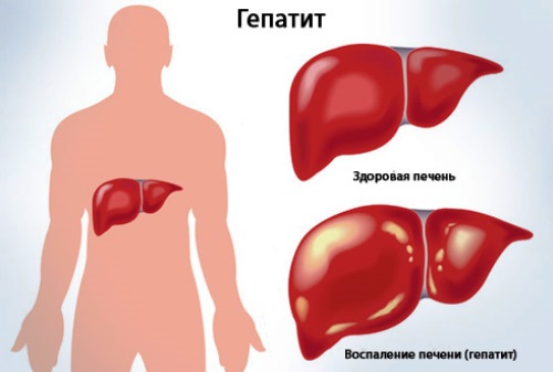 Что такое гепатит Гепатит