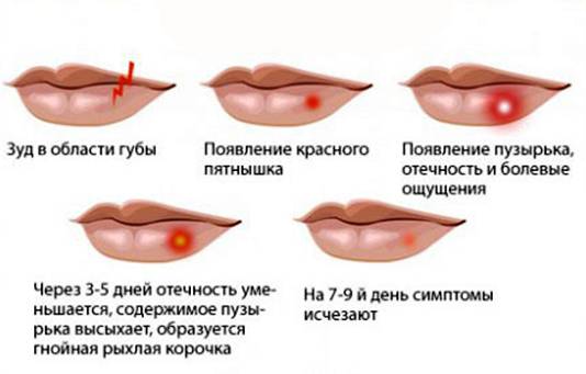 Как проявляется герпес на губах Герпес на губах