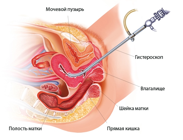 Процедура гистероскопии Гистероскопия