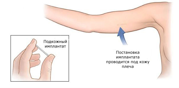 Гормональный имплант Гормональный имплант как средство контрацепции
