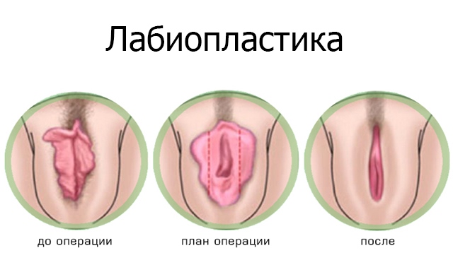 Интимная пластика Интимная пластика после родов