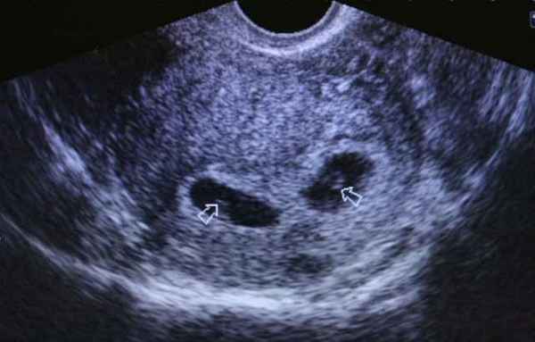 многоплодная беременность