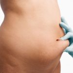 Способы подтяжки кожи на животе после родов Как подтянуть кожу на животе после родов