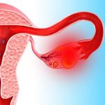 Причины кисты после родов Киста после родов