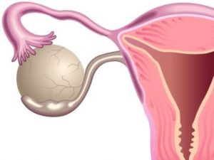 kista-posle-rodov Киста после родов