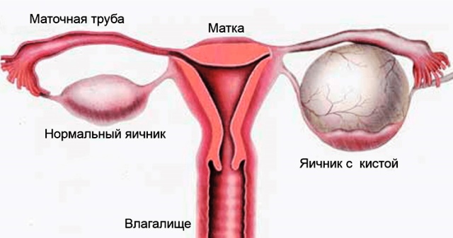 Киста яичника Киста яичника после родов