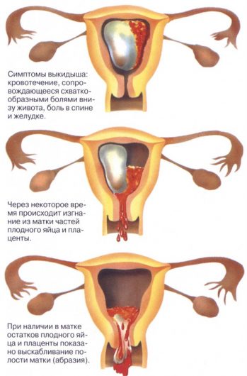 коричневая мазня при беременности на ранних сроках