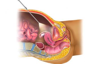 laparoskopiya-na-rannem-sroke Лапароскопия на раннем сроке