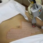 Применение лазера от растяжек после родов Лазер от растяжек после родов