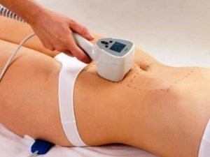 lazer-ot-rastyazhek-posle-rodov Лазер от растяжек после родов