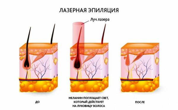 Лазерная эпиляция Лазерная эпиляция после родов