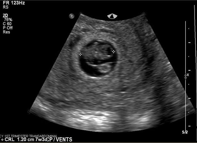 диагностика маловодия