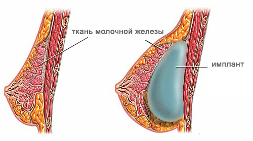 Маммопластика Маммопластика после родов