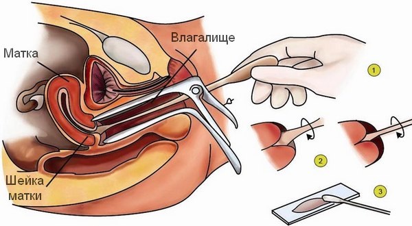 мазок из влагалища